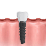 implant illustration